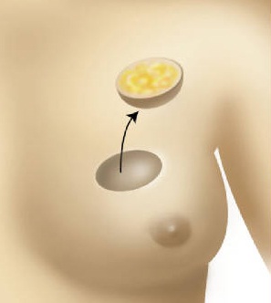 Lumpectomy of the Breast
