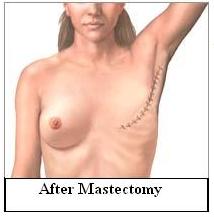 Mastectomy of the Breast