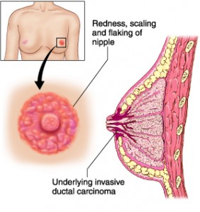 Paget's disease of the breast Overview - Mayo Clinic