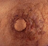 Eczema – Nipple Eczema | Perri Dermatology
